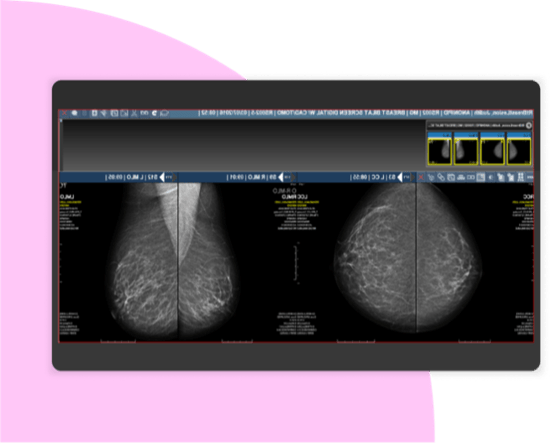 SCR-Merge-PACS-Mammo-008-1125x912